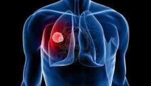 Brasil assume conselho de entidade que combate a tuberculose no mundo