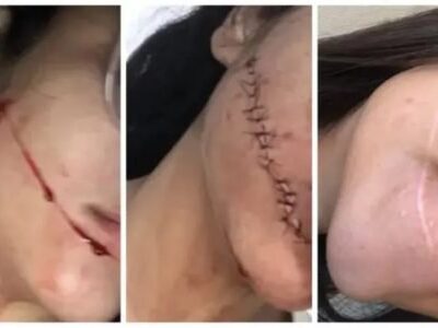 “Não conseguia me olhar no espelho”, diz jovem que teve rosto cortado
